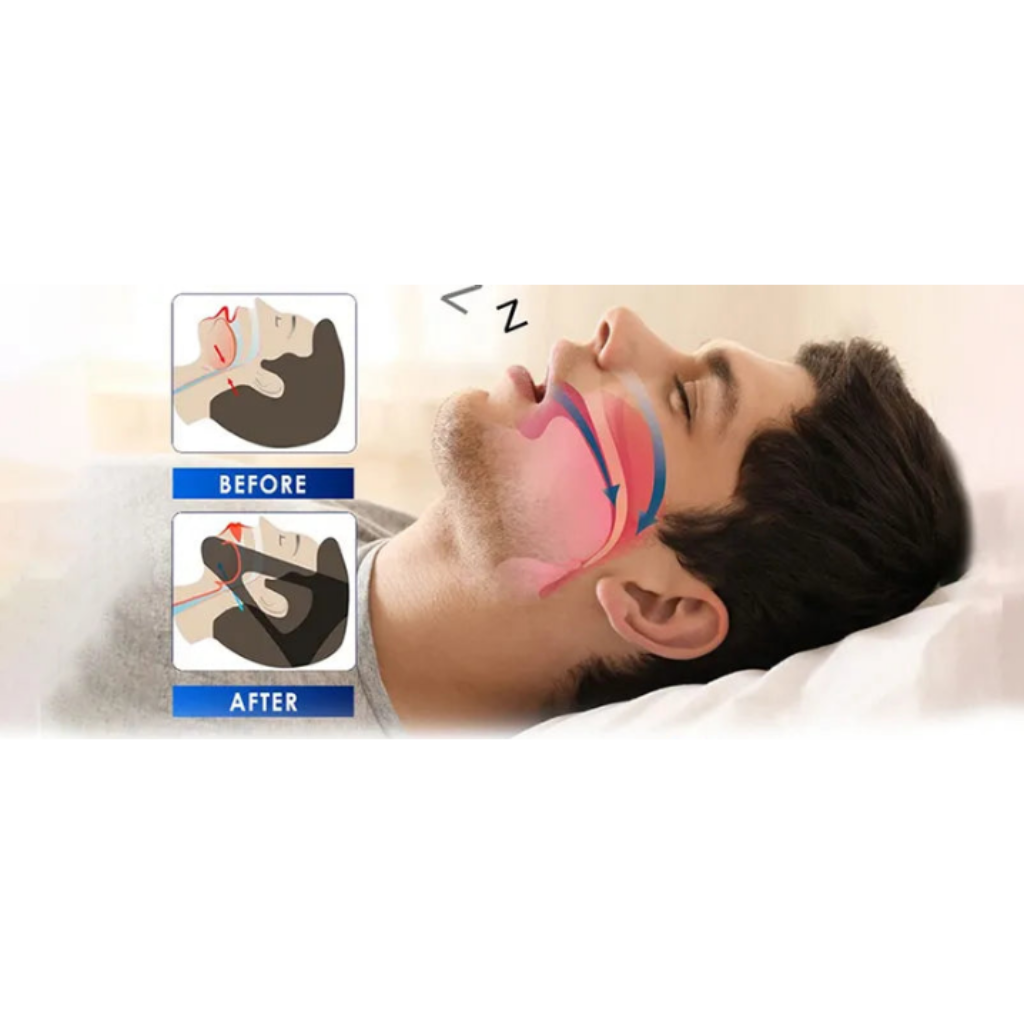 1 PC Silicone Anti-Snoring Corrector